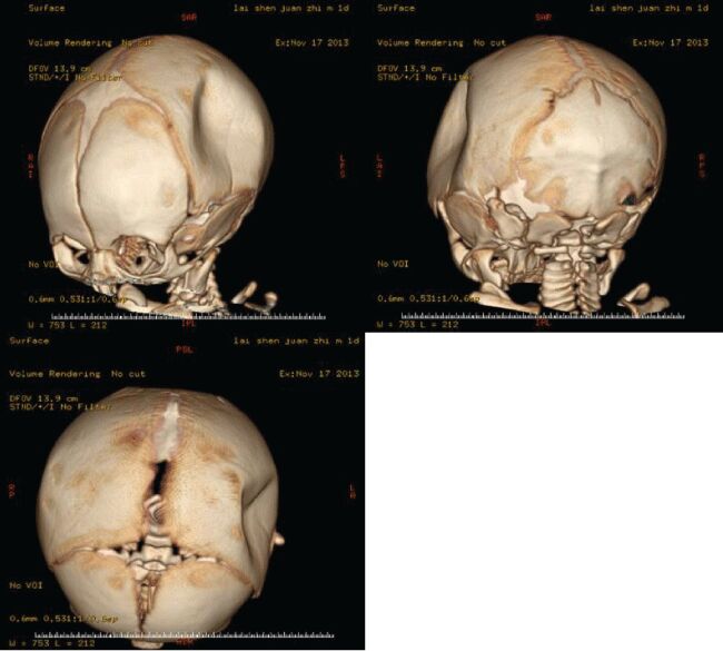 Depressed Skull Fracture Surgery in a 1-Year-Old | Dr. Mustafa Chandshah, Neurosurgeon, Hubli, North Karnataka