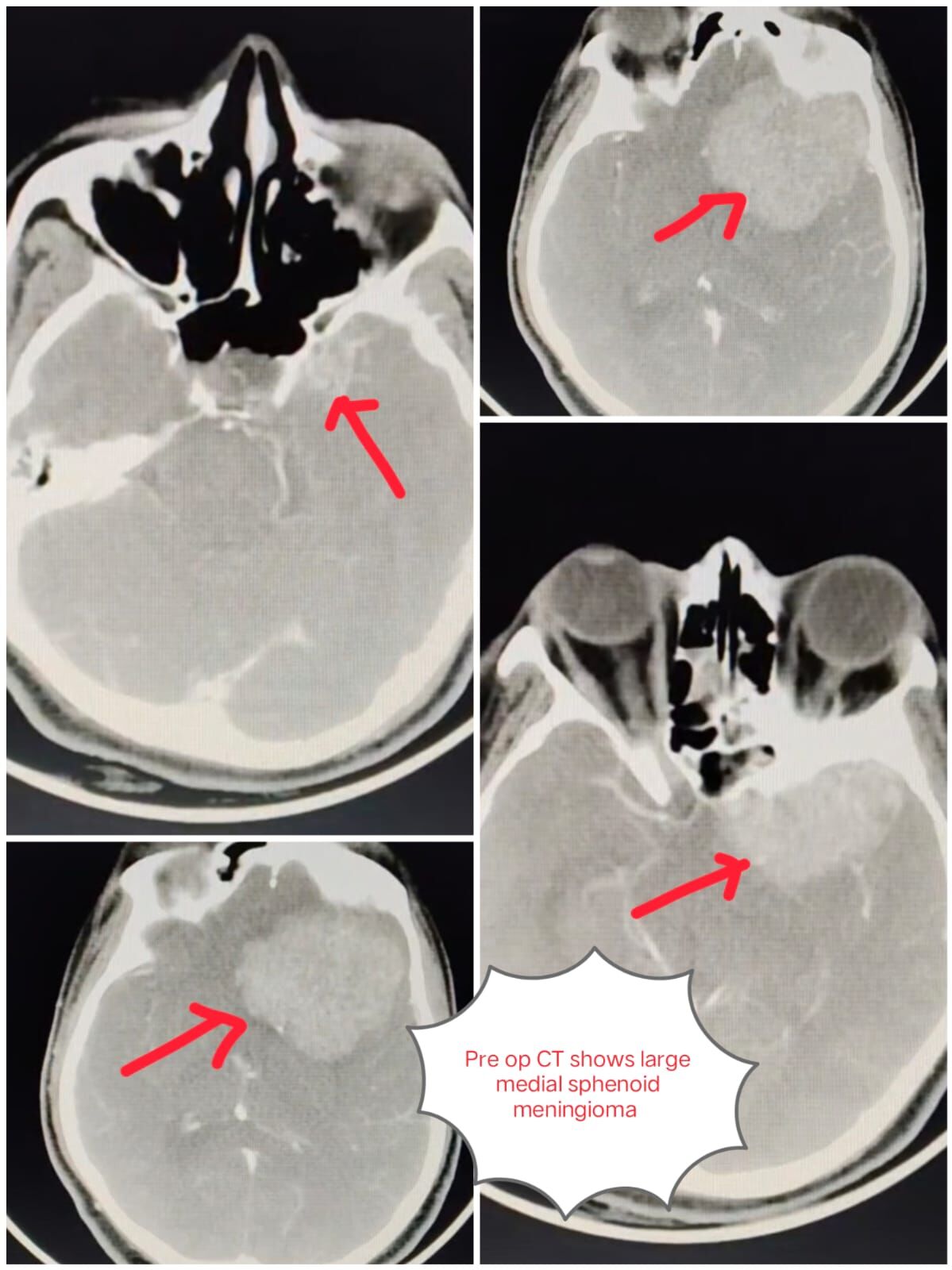 "A Battle Near the Optic Nerve – Winning Against a Giant Brain Tumor" (ದೃಷ್ಟಿನಾಳದ ಹತ್ತಿರದ ಹೋರಾಟ – ಬೃಹತ್ ಮೆದುಳು ಗಂಧಮಾಲೆಯ ವಿರುದ್ಧದ ಜಯ) – Dr. Mustafa Chandshah | Consulatant Neurosurgeon, Hubli, Karnataka