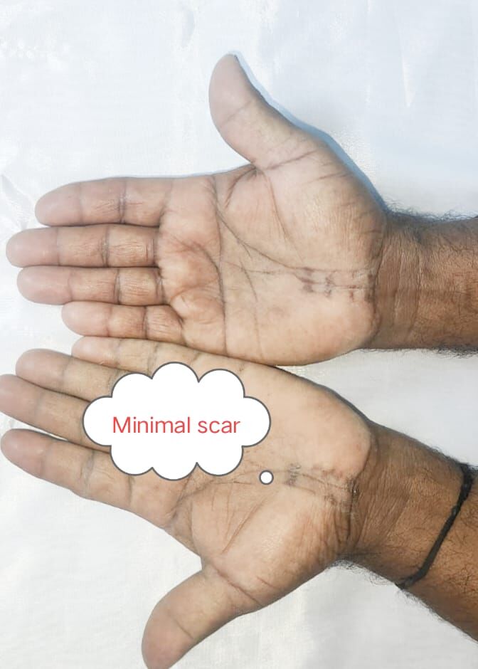 “Hands that Build, Shouldn’t Suffer”– Timely Carpal Tunnel Surgery Makes Life Pain-Free | Dr. Mustafa Chandshah | Leading Neurosurgeon in Hubli, Karnataka