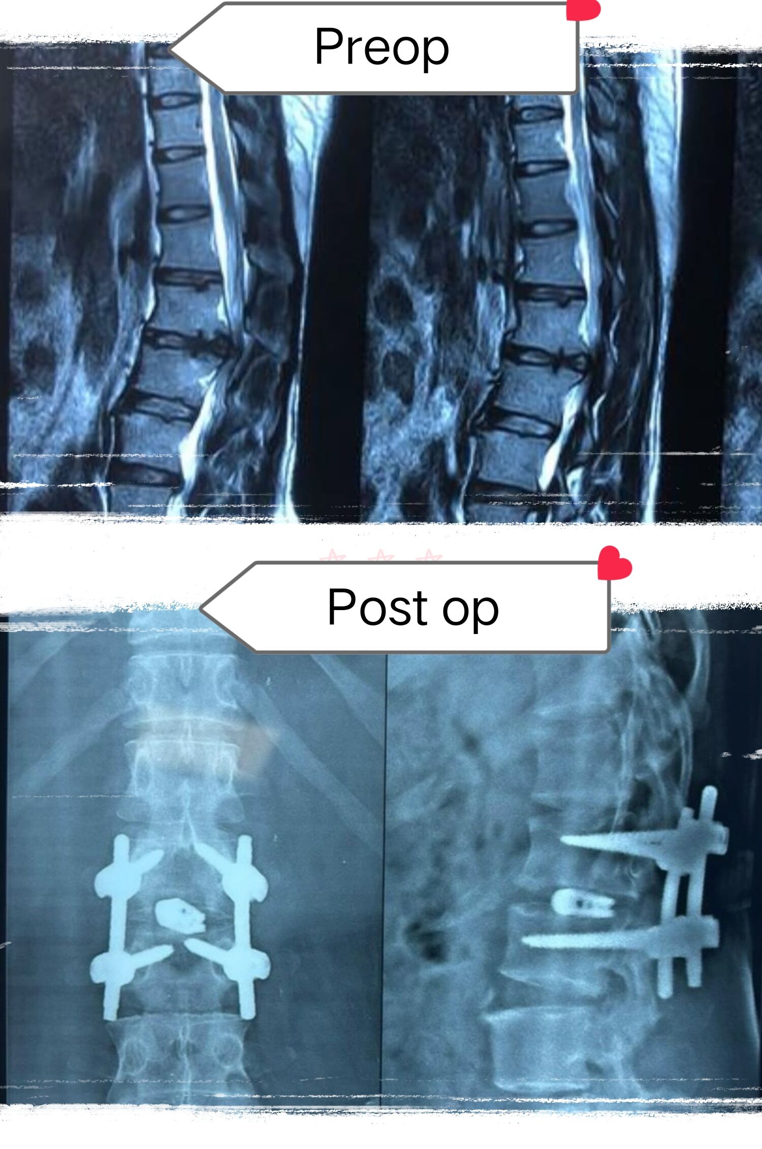 “TLIF Surgery: A New Ray of Hope for Spine Pain” |TLIF – ಬೆನ್ನುಹುರಿಯ ಶಸ್ತ್ರಚಿಕಿತ್ಸೆಯ ಹೊಸ ಭರವಸೆ | Dr. Mustafa Chandshah – Neurosurgeon, Hubli, Karnataka
